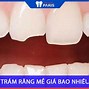 Hàn Răng Mẻ Giá Bao Nhiêu